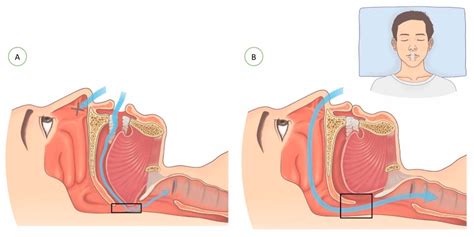 Mouth Taping: Viral Fad or Evidence-Based Treatment for Mouth Breathing ...