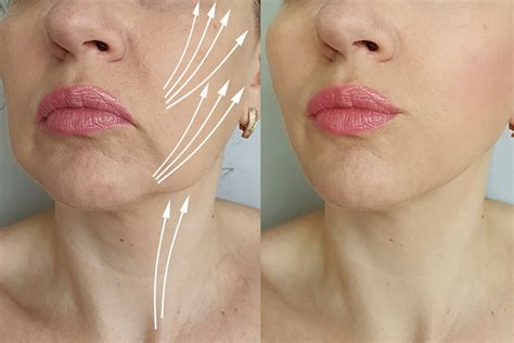 Mini vs. Full Facelift: Choosing the Right Procedure for You