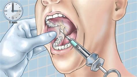 Standard Inferior Alveolar Nerve Block - YouTube