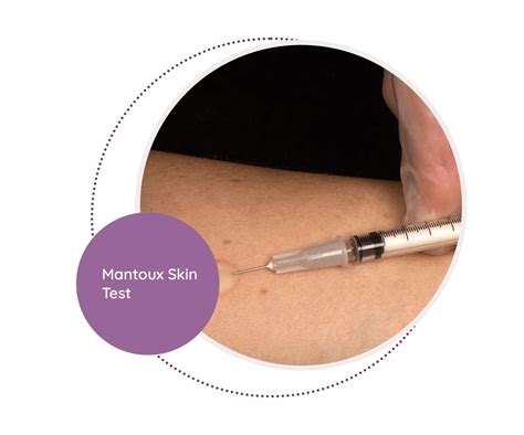 Mantoux Skin - MediScan Lab