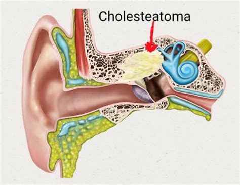 Cholesteatoma Ear Surgery