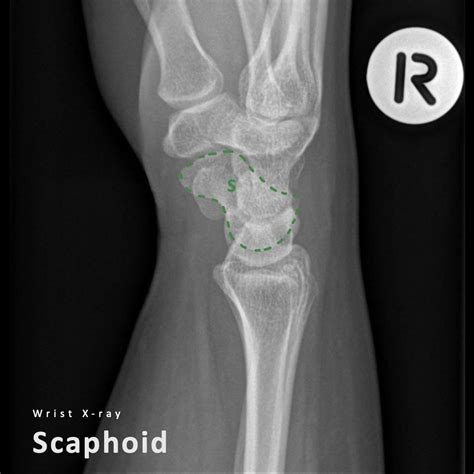 Normal Anatomy of Lateral Wrist Radiograph - PULSE MD