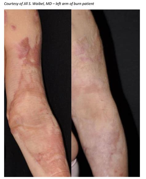 Early Treatment Is Revolutionizing Outcome Of Burn Scars