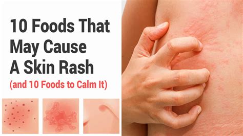 Which of the following diseases causes a skin rash Resolve | abouthairloss