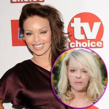 Former Model Acid Attack Victim Katie Piper Reveals Her Miraculous Recovery