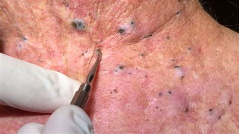 Dr Sandra Removing Huge Blackheads