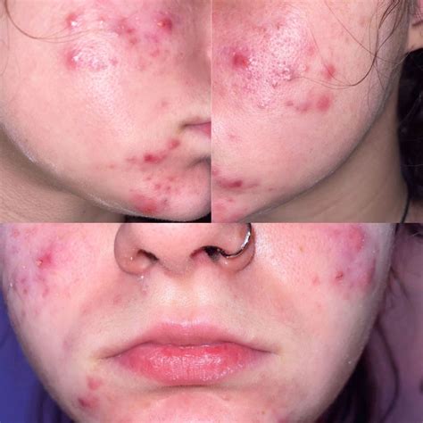 Accutane Before and After: What I Wish I Knew About Isotretinoin