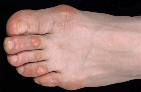 Lump On Toe: Causes & Treatment For Toe Lumps & Bumps