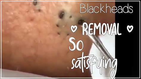 Newest Blackhead Removal Videos April 2024 - Joye Ruthie