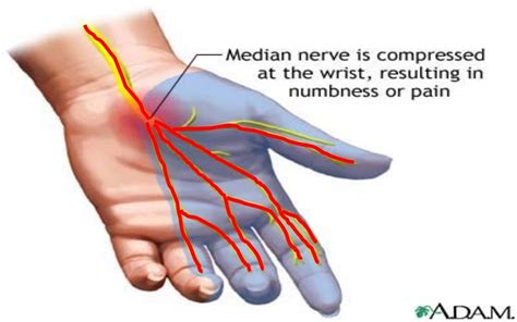 Median nerve injuries