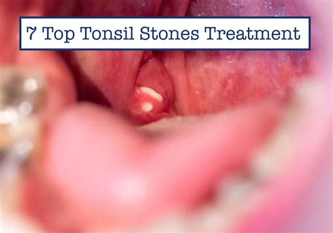 7 Top Tonsil Stones Treatment