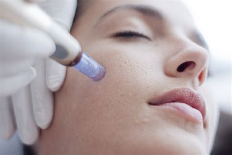 Skin needling: The secret to looking noticeably youthful - The Temple ...