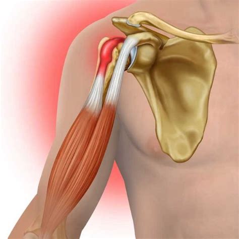 Arthroscopic or Open Biceps Tenodesis | Shoulder Surgeon | South ...