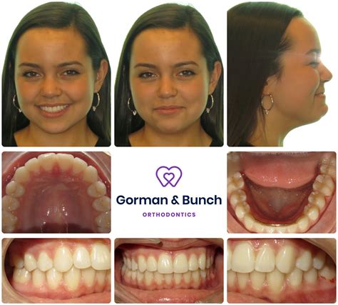 Invisalign Before and After Stories With Our Patients – Gorman & Bunch