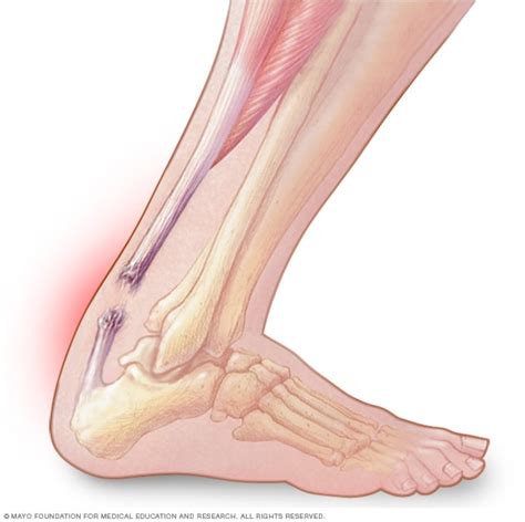 Achilles Tendon Rupture – Rupert Health Centre Inc Blog