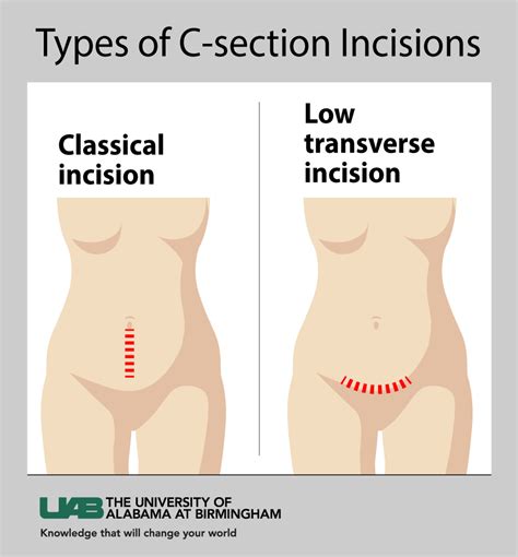 UAB investigators find repeat cesarean deliveries less cost-effective ...