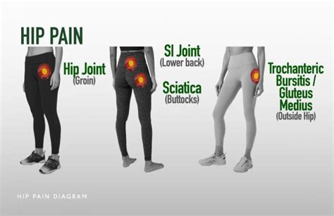 Non-Surgical Hip Pain Treatment Chicago, IL | Dr. Jorge Chahla