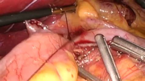 Omega loop duodenal switch with linear stapled duodenoileostomy ...