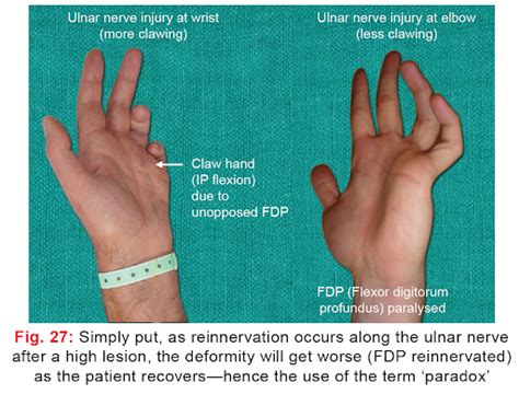 Anatomical Basis Of Ulnar Paradox, 43% OFF