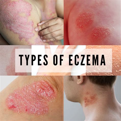 7 Types Of Eczema