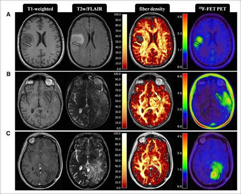 Brain and Spinal Cord Tumors (also called Central Nervous System) - SNMMI