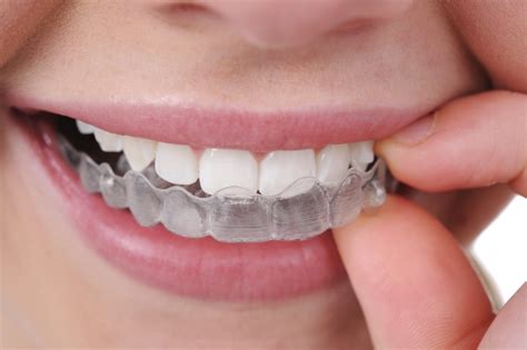 Average Cost Of Clear Braces at Marie Hall blog