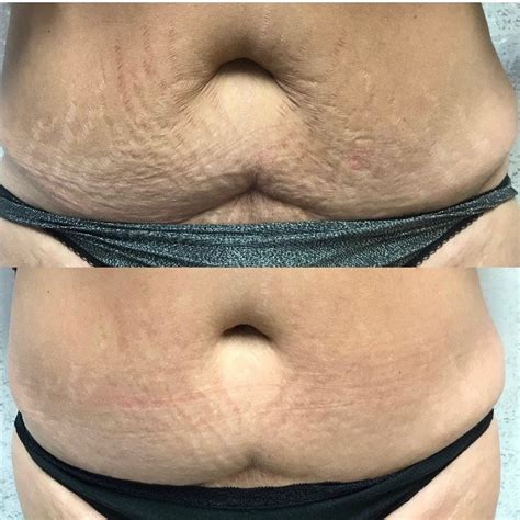 Before & After Eximia 3rd Treatment Success Photo. Non-Surgical, Non ...