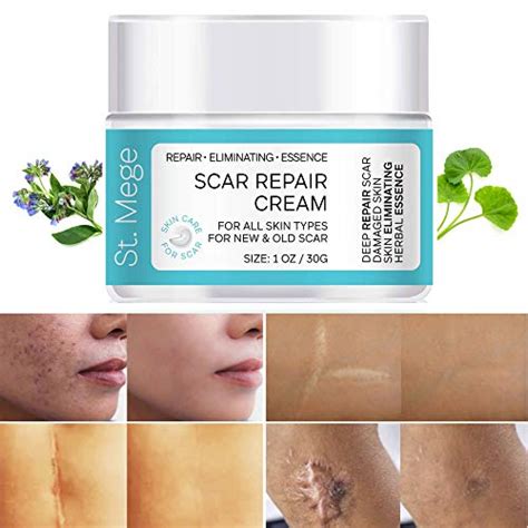 The 12 Best Scar Creams in 2021 - Top Picks & Buying Guide