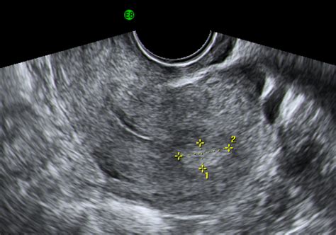 Chapter 6 – Endometrial polyps – Melaka Fertility