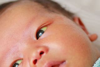 what is jaundice in babies nhs - All Was Well Online Journal Pictures