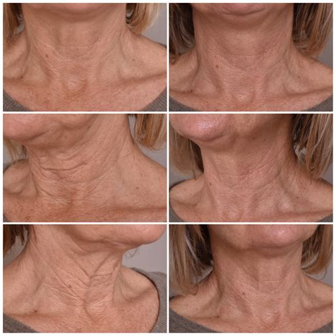 Laser Skin Tightening | Sydney Cosmetic Laser | La Sante