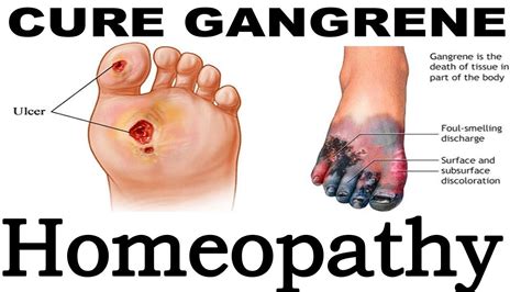 Gangrene - Discussion and Treatment in Homeopathy | Dr P.S. Tiwari ...