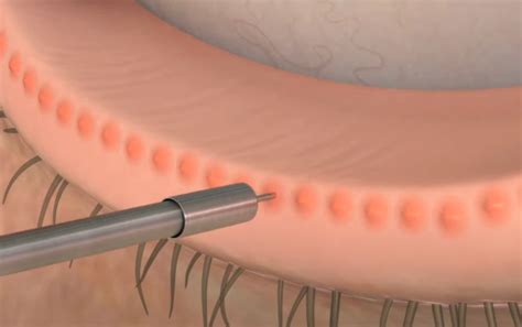 Meibomian Gland Probing - Dry Eyes Clinic