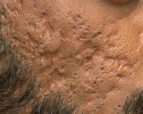 Scarring from cystic acne - Stock Image - C050/1008 - Science Photo Library