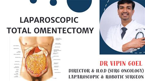 Laparoscopic Total Omentectomy by Dr Vipin Goel - YouTube