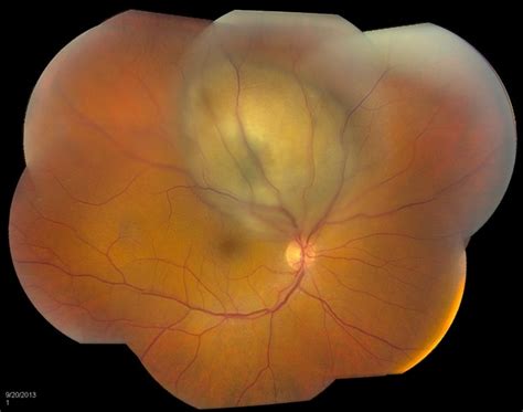 Melanoma of the retina