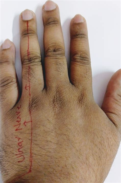 Ulnar Claw Hand and Ulnar Paradox - RayOrthos