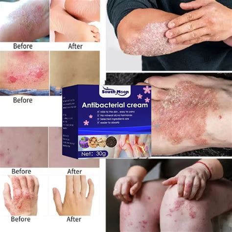 Atoderma Cream Psoriasis Cream Eczema Treatment Cream For Itchy Skin ...