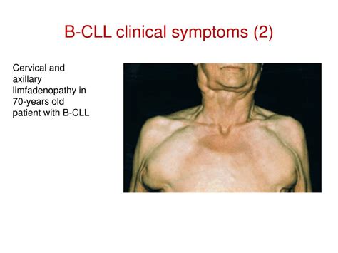 PPT - The Chronic Lymphocytic Leukemia (CLL) PowerPoint Presentation ...