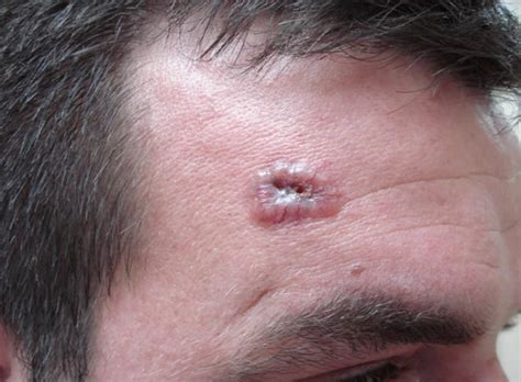 Basal Cell Carcinoma - Causes, Types, Symptoms, Prognosis, Treatment