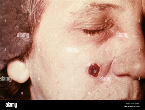 Anthrax lesion hi-res stock photography and images - Alamy