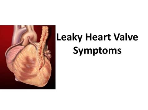 Asian Heart Institute - Leaky heart valve symptoms