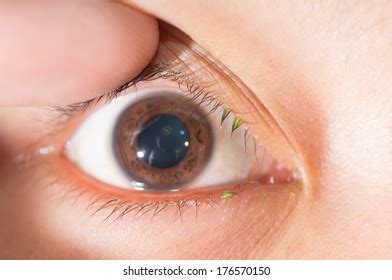 Close Corneal Metallic Foreign Body During Stock Photo (Edit Now) 176570150