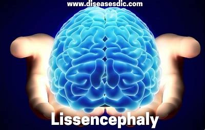 Lissencephaly- Causes, Symptoms and Treatment