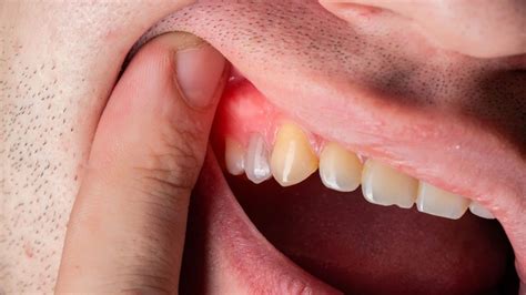 11 Home Remedies For Swollen Gums