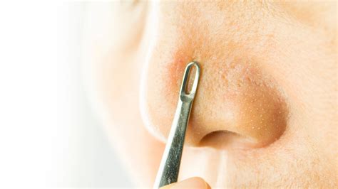 This "Blackhead Popping" Video Shows the Wrong Way to Do Extractions ...