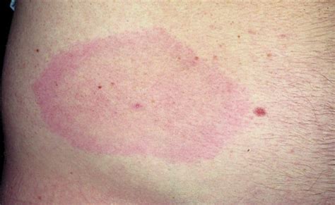 The characteristic bullseye rash for Lyme disease | Innatoss