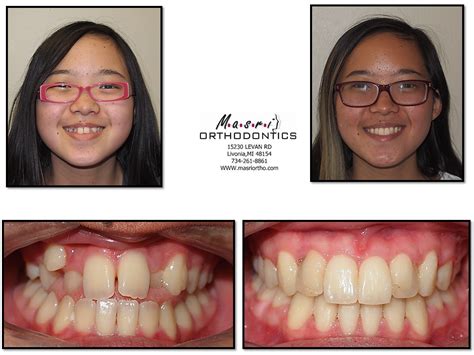 Open Bite Jaw Surgery & Braces Before and After Treatment