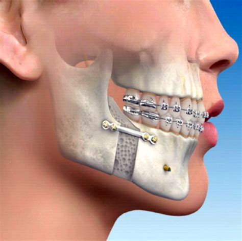 jaw-surgery-osteotomy - Pacific Oral Surgery