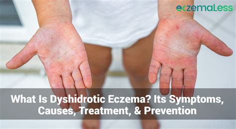 What Is Dyshidrotic Eczema? Its Symptoms, Causes, Treatment ...